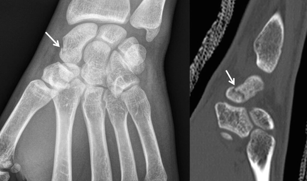 Douleur au poignet : pourrait-il s&rsquo;agir d&rsquo;une fracture du scaphoïde ?
